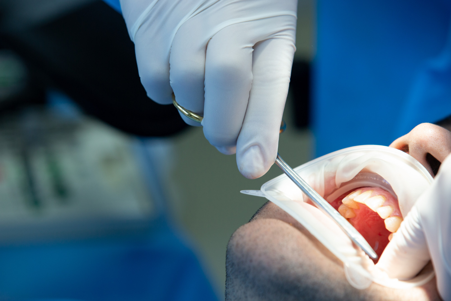 La cirugía oral como clave para una salud dental completa